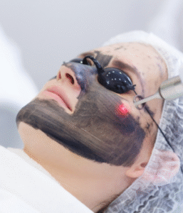 Peeling hollywood Laser com Mascara preta