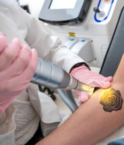 Remoção de tatuagem